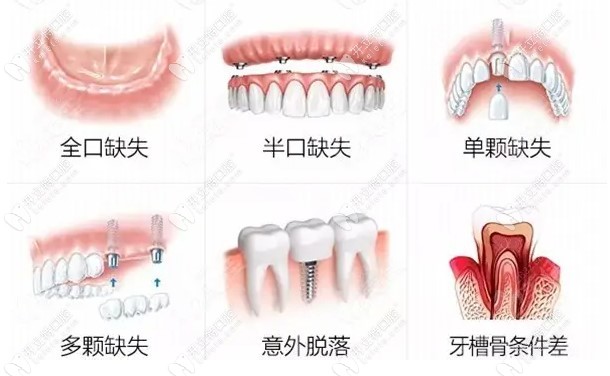 糖尿病、高血压种植牙注意事项有