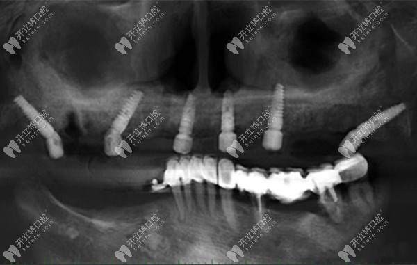 上半口种六颗种植牙的图