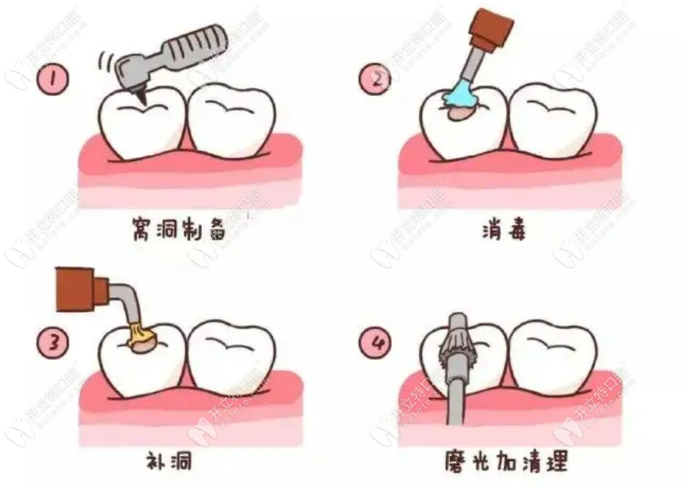 乳牙龋病应如何预防