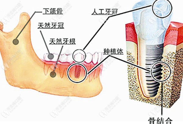 种植牙在牙槽骨内的图