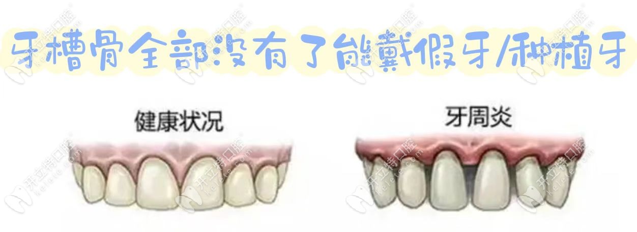 牙槽骨全部没了能戴假牙吗?可以戴假牙,也可以做种植牙修复