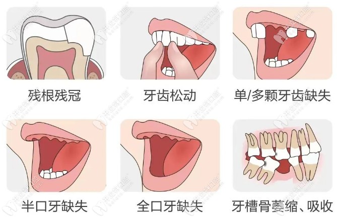 不同的牙齿缺失情况