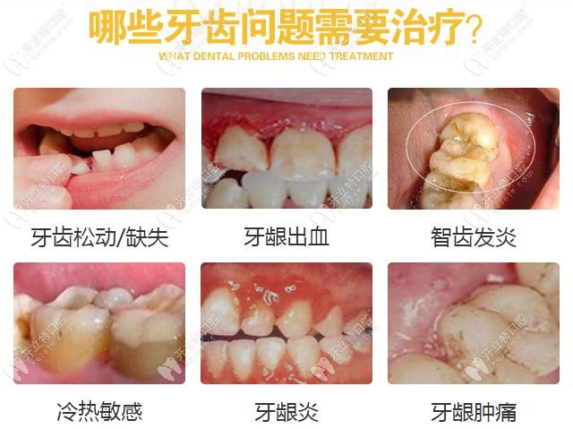 宁德蕉城博仕齿科拔智齿价格