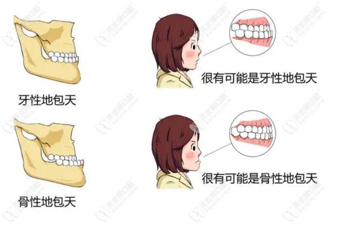 怎么区分骨性地包天和牙性地包天