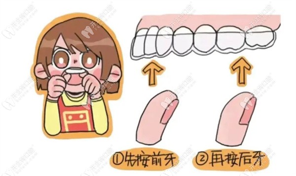 隐形牙套的正确佩戴方法