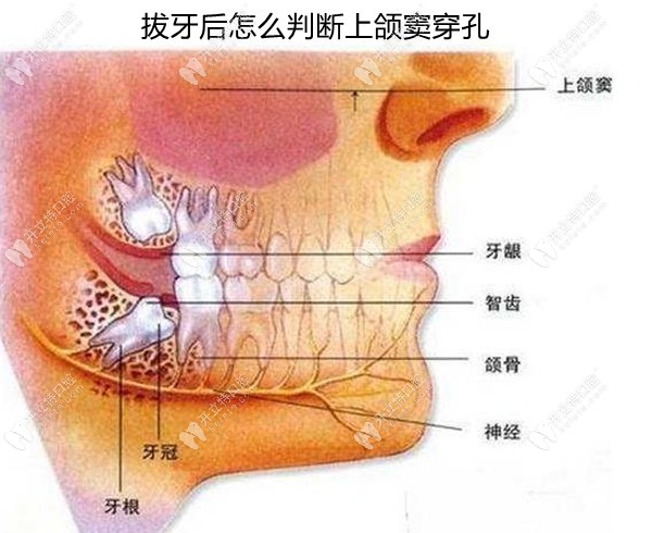 拔牙后怎么判断上颌窦穿孔？速看拔智齿上颌窦穿孔的表现