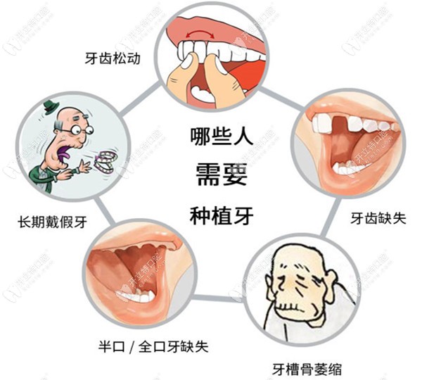 晋江修大夫口腔进口种植牙价格