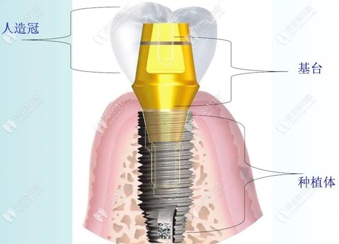 种植牙结构解剖图