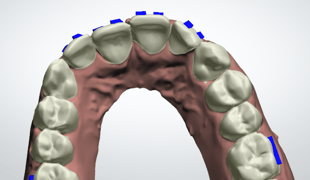 牙齿矫正动画模拟方案设计