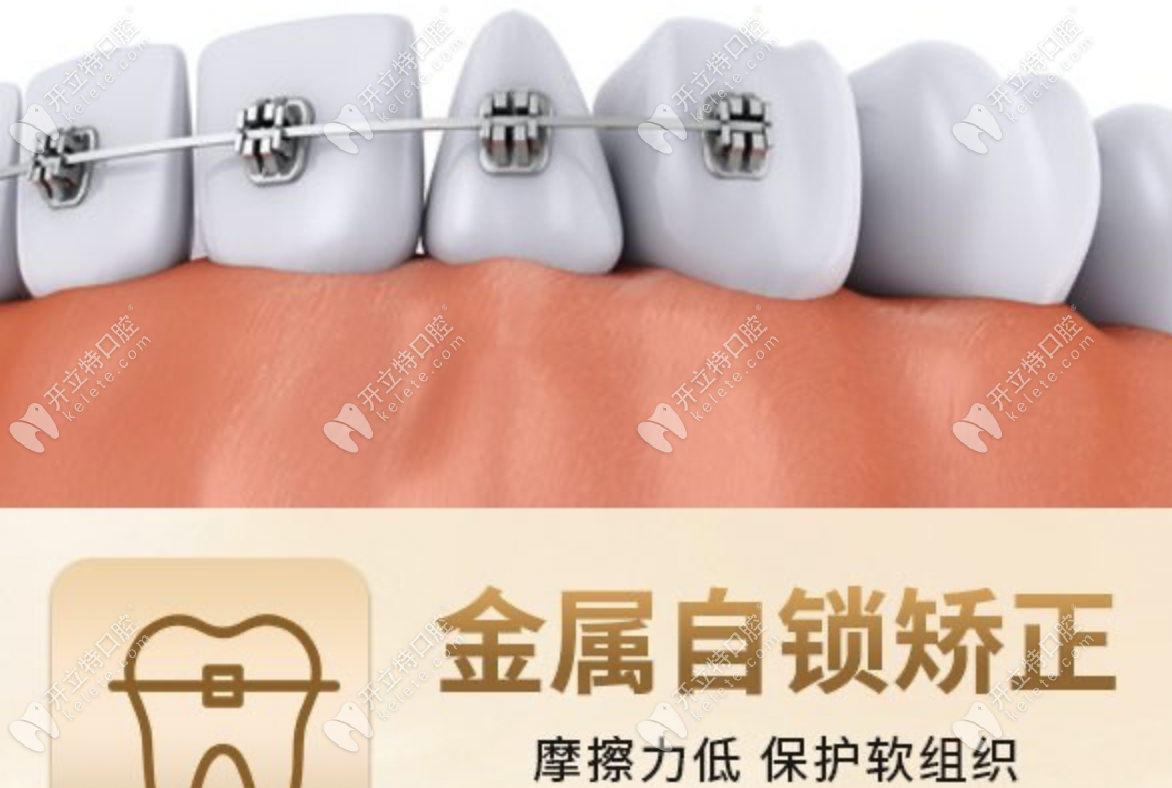 邵阳洞口县口腔医院牙齿矫正价格在6000-30000元左右