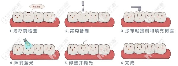 补牙流程示意图