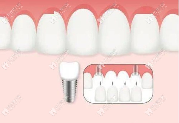 种植牙的图片www.kelete.com