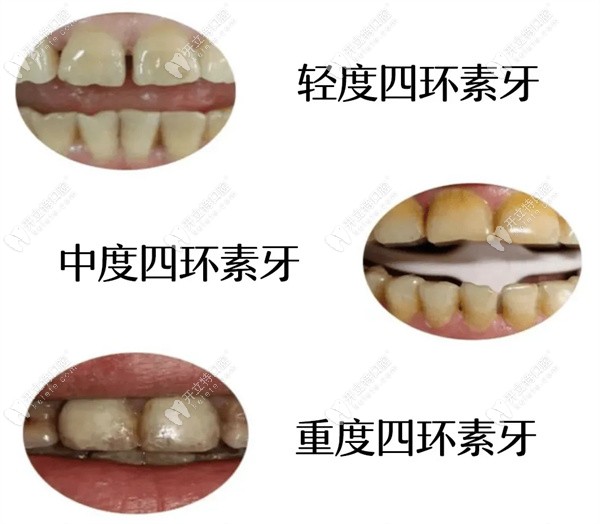 氟斑牙和四环素牙的区别是什么