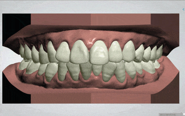牙齿矫正动漫模拟图