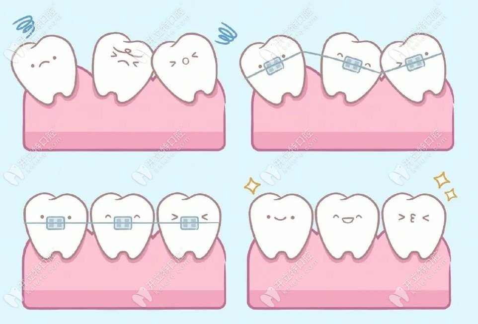 贵阳牙博士矫正牙齿多少钱？