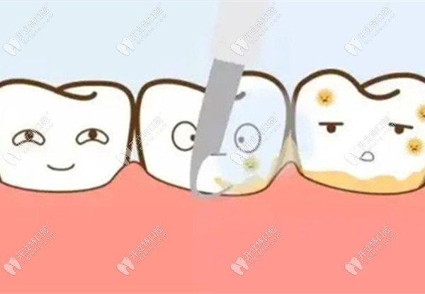 牙周刮治的图片www.kelete.com