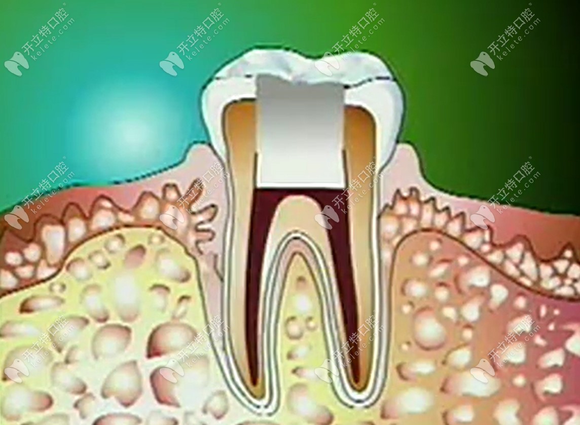 牙齿塑化治疗的示意图kelete.com