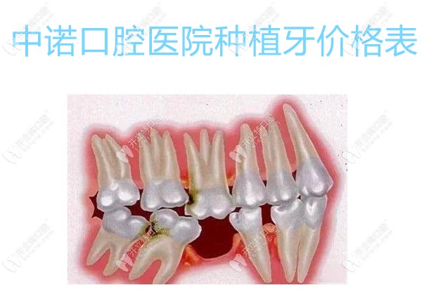 中诺口腔医院种植牙价格表含中诺一颗3890起,全口3.6万元起