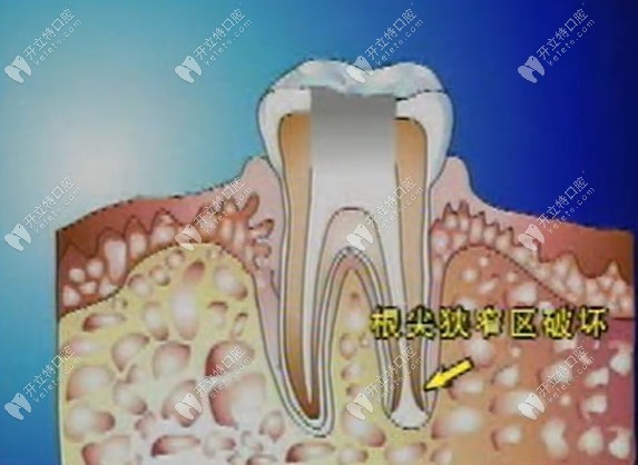 牙齿塑化治疗禁忌症