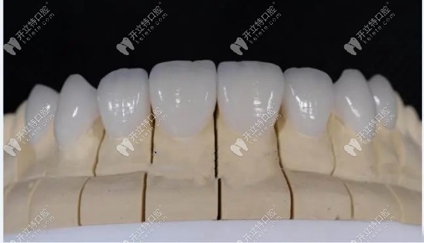 瓷贴面可以改善四环素牙
