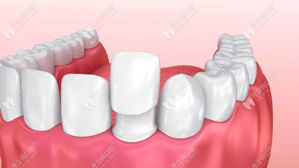 在重庆何智强口腔做瓷贴面改善氟斑牙的过程