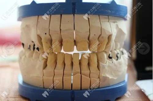 磨完牙后的牙齿模型图