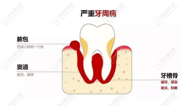 瘘管已经发展到牙周问题