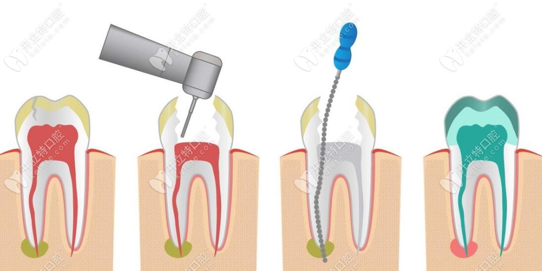 根管治疗的整个过程