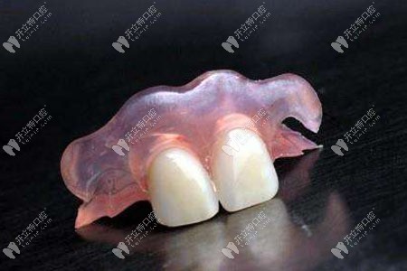 掉了一颗门牙活动义齿可修复