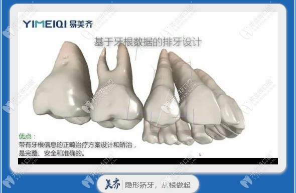 国产易美齐隐形牙套,可用于偏骨性Ⅲ类的牙列拥挤病例矫正