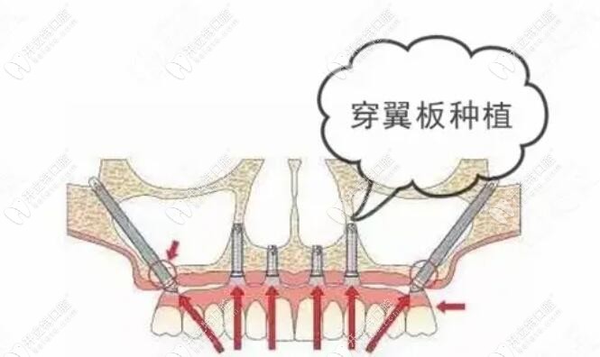 穿翼板種植牙技術(shù)