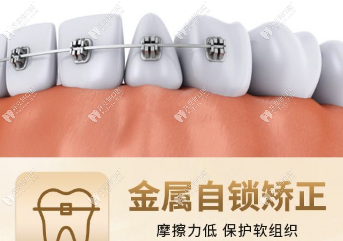 婁底八顆牙口腔金屬矯正