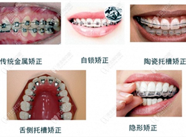 牙齿矫正器的各种类型www.kelete.com