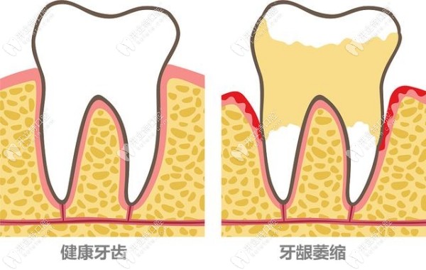 牙龈萎缩导致牙根外露怎么办?听说牙根外露做根管治疗能行