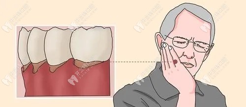 预防牙龈萎缩导致牙根外露