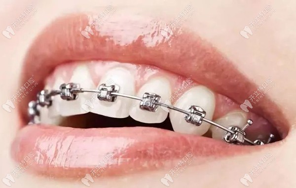 西安美奥口腔医院金属自锁牙套多少钱