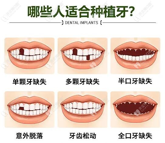 2024深圳龙华区种植牙价格表:单颗种植牙3千+/半口种植牙2万+