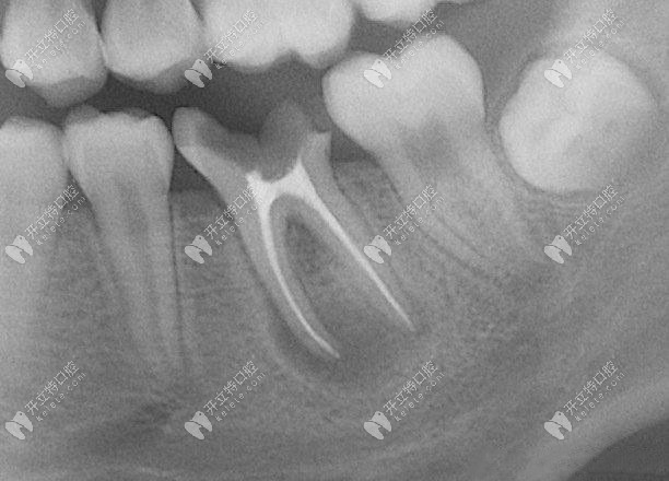 牙齿根管治疗有必要吗？www.kelete.com