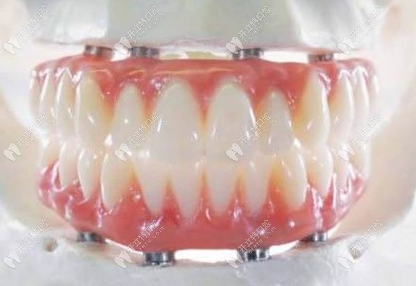全口种植牙的图片www.kelete.com