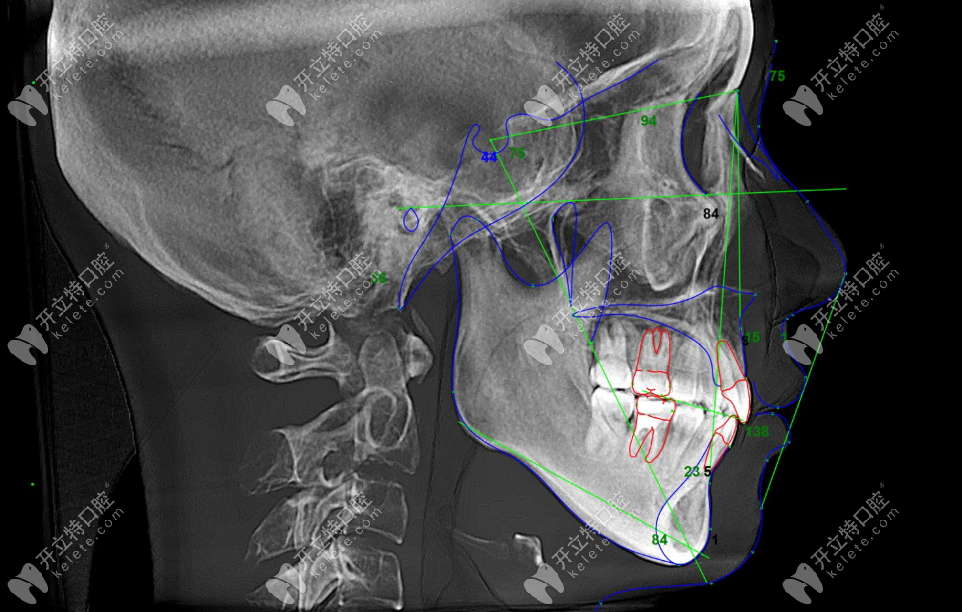 骨性Ⅱ类病人下巴后缩