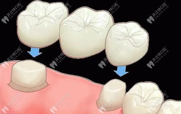 大牙镶牙的修复方式示意图