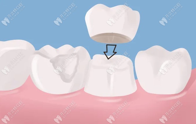 全瓷牙冠修复牙缝大