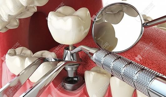 太原众牙口腔医院种植牙费用，中德合资种植牙3820元起一颗