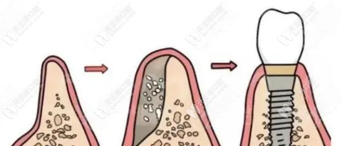 种植牙植骨