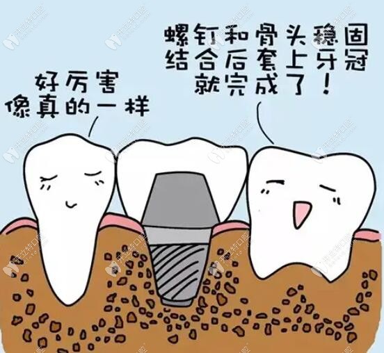 哈尔滨种植牙价格公布,可查询到哈尔滨进口种植牙多少钱