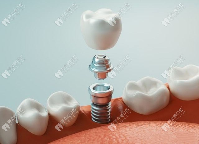 绵阳牙科收费价目表——种植牙