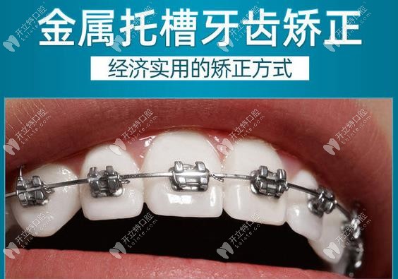 仙游京福口腔医院传统金属固定牙齿矫正价格