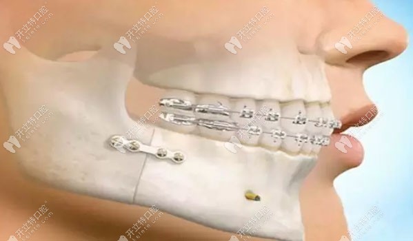 广东省牙科医院做正颌手术的费用