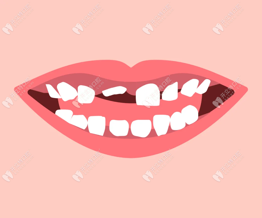 上门牙缺失一颗戴隐形义齿可以吗?缺牙的3种修复方式公布