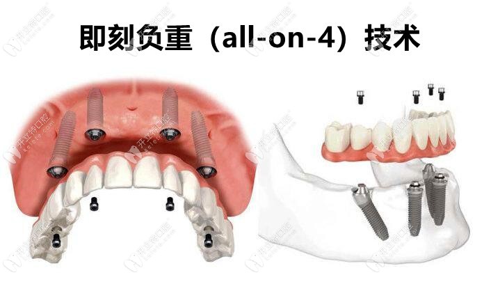 蘆淞佳美口腔數(shù)字化即刻負重種植牙技術(shù)